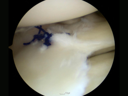 반월상 연골 방사형 파열에 대한 봉합술 사진
