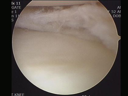 반월상 연골의 복합 파열에 대한 부분 절제술 사진
