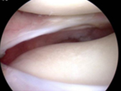 반월상 연골 결손에 대한 반월상 연골 이식술 사진