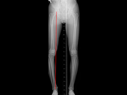 무게 중심이 무릎 내측으로 이동된 상태로 퇴행성 관절염 진행이 빠를 것으로 예상