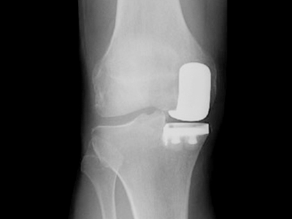 무릎 인공관절 부분 치환술 방사선 사진