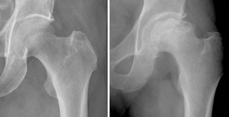 정상 고관절 방사선 사진과 괴사로 인해 대퇴골두가 붕괴된 방사선 사진