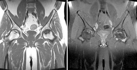 대퇴골두 무혈성 괴사 소견을 보여주는  MRI 사진